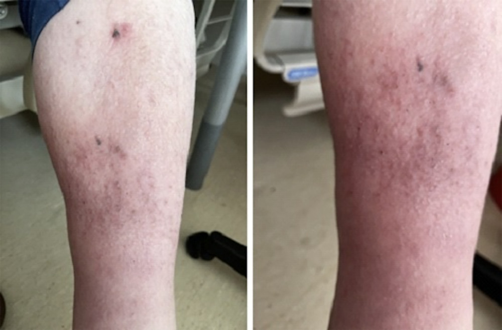 Severe linear excoriations on the patient’s calves, attributed to chronic pruritus. The photograph was taken during the most recent admission in May 2024, at a time when pruritus had slightly decreased. The distribution and morphology of the lesions suggest a secondary etiology, consistent with CKD-aP. The absence of primary dermatologic pathology supports a systemic origin.