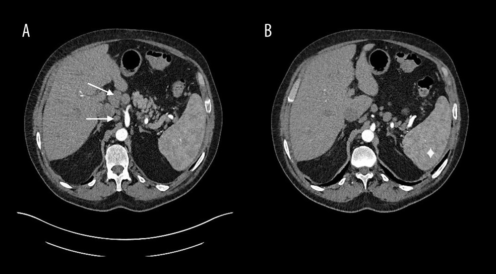 (A, B) CT scans performed on admission to our hospital. The image presents CT of the abdomen performed on admission in October 2023. The enlargement of the spleen and lymphadenopathy are shown. The diamond has been placed to show the spleen, while the arrows point to abnormal lymph nodes.