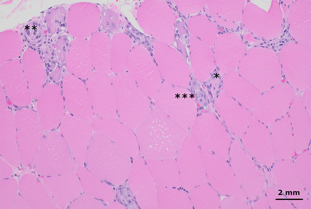 Hematoxylin and eosin-stained sections from formalin-fixed paraffin-embedded skeletal muscle tissue shows myofibers at different stages of degeneration and regeneration, including necrosis (*), myophagocytosis (**), and basophilic fibers (*** left of basophilic fibers). These changes affected a minority of the muscle tissue and were diffusely distributed throughout the muscle fascicles, without an obvious perifascicular pattern. There was no significant lymphocytic inflammation (200× total magnification).