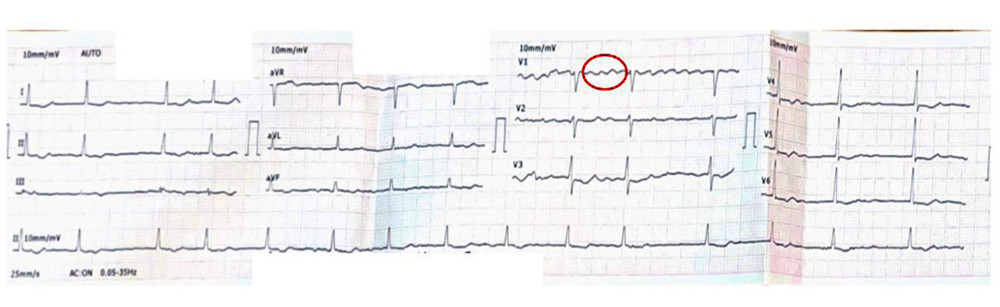 Electrocardiogram of paroxysmal anticlockwise re-entry atrial flutter, indicating right isthmus dependenceA “sawtooth” pattern of inverted flutter waves is present in leads II, III; an augmented vector foot and upright flutter waves are present in lead V1 (red circle).