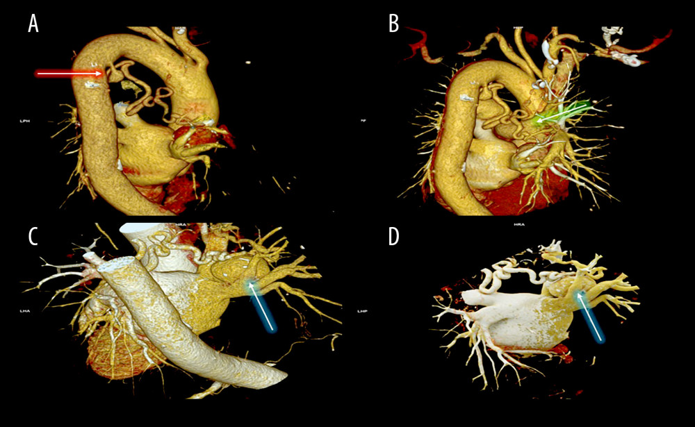 Three-dimensional computed tomography volume-rendering technique reconstruction of the bronchial arteriovenous malformation(A) Meandering course of the bronchial artery with a small aneurysm indicated near its origin from the thoracic aorta (red arrow). (B) The bronchial artery drains into the right pulmonary artery through a small branch (green arrow). (C, D) A larger saccular aneurysm with mural calcifications is noted distally along the bronchial artery near the left atrium (blue arrows).