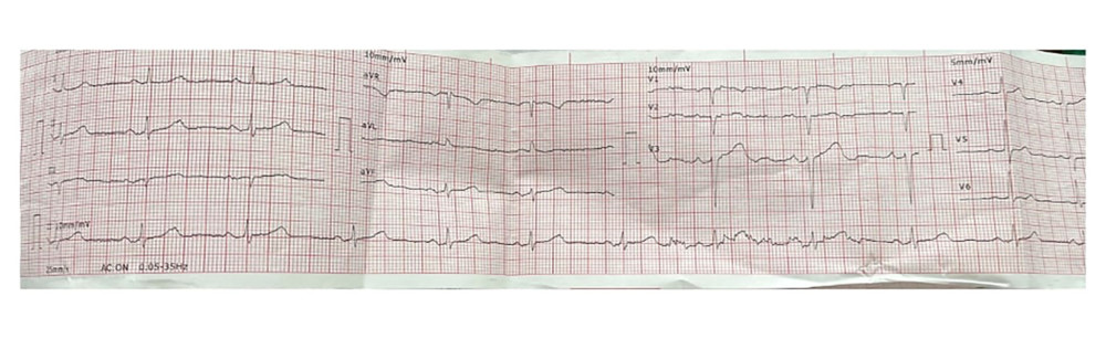 Resting electrocardiogram in sinus rhythm (55 beats/min)No cardiac pathology is present.