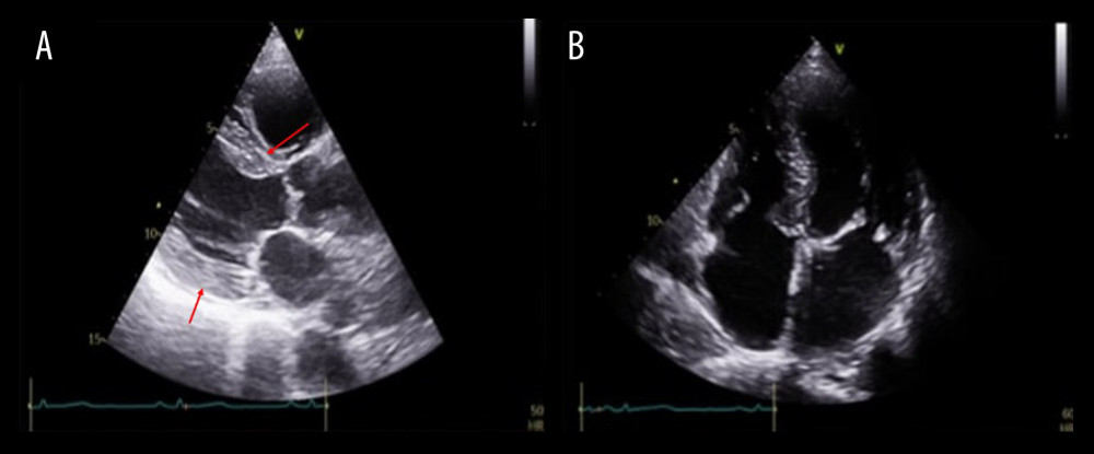 Transthoracic echocardiography(A) Parasternal long-axis view shows mild left ventricular hypertrophy (red arrows indicate interventricular septum and posterior wall of the left ventricle) due to arterial hypertension, with normal left ventricular size. (B) Apical 4-chamber view depicts normal biatrial size. Left ventricular function is within normal range.