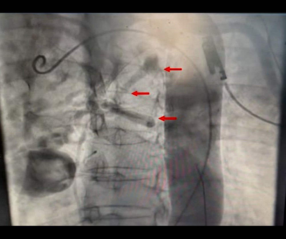 Invasive aortography assessment of the bronchial arteriovenous malformation (BAVM)Selective aortography demonstrates the BAVM arising from the descending thoracic aorta (red arrows). Opacification of drainage into the pulmonary artery is limited, likely due to contrast dilution within the pulmonary circulation.