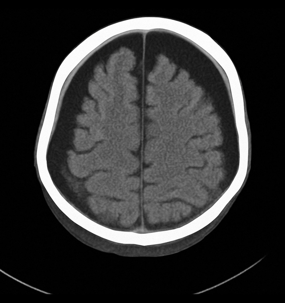 Axial computed tomography scan of the brain showing bilateral subdural hygroma and mild cerebral atrophy, consistent with chronic intracranial complications secondary to recurrent infections in X-linked agammaglobulinemia (Case 1).