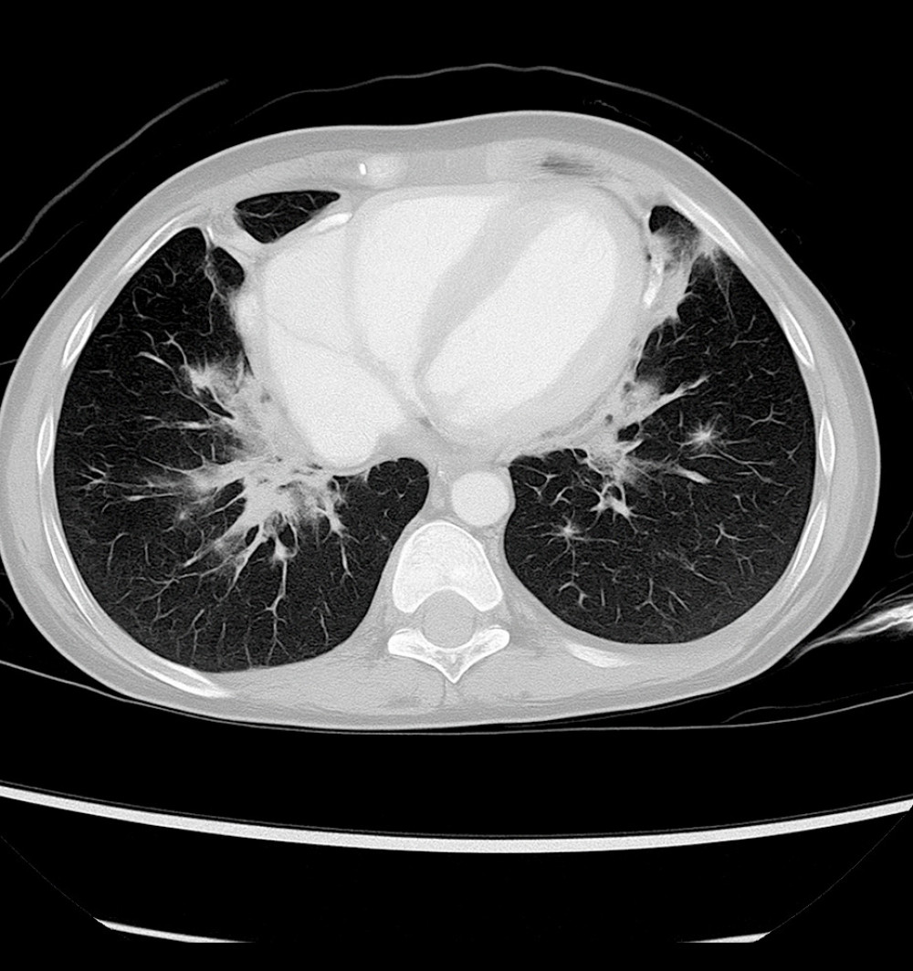 Axial chest computed tomography image showing bilateral pulmonary infiltrates with areas of patchy consolidation (Case 2).
