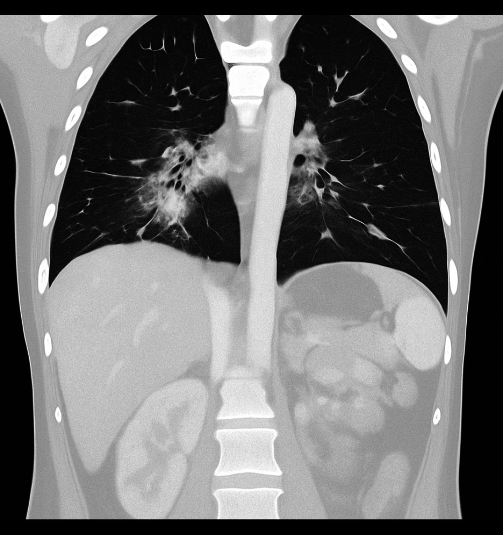 Coronal chest computed tomography image showing ground-glass opacities predominantly in the perihilar regions, consistent with an infectious or inflammatory process (Case 2).