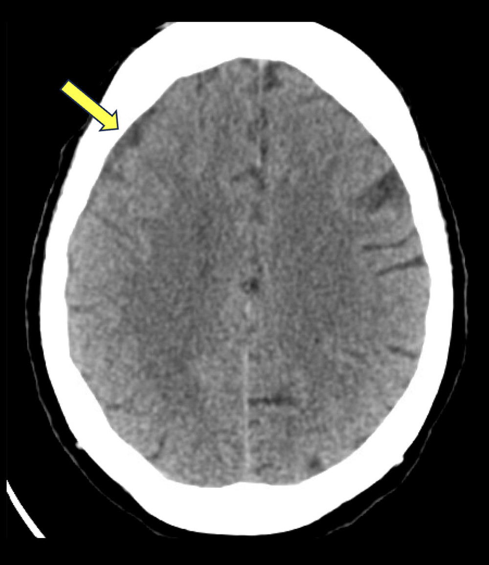 Increased density in the extra-axial space is seen on initial CT brain without contrast, most commonly seen in subdural hematoma.