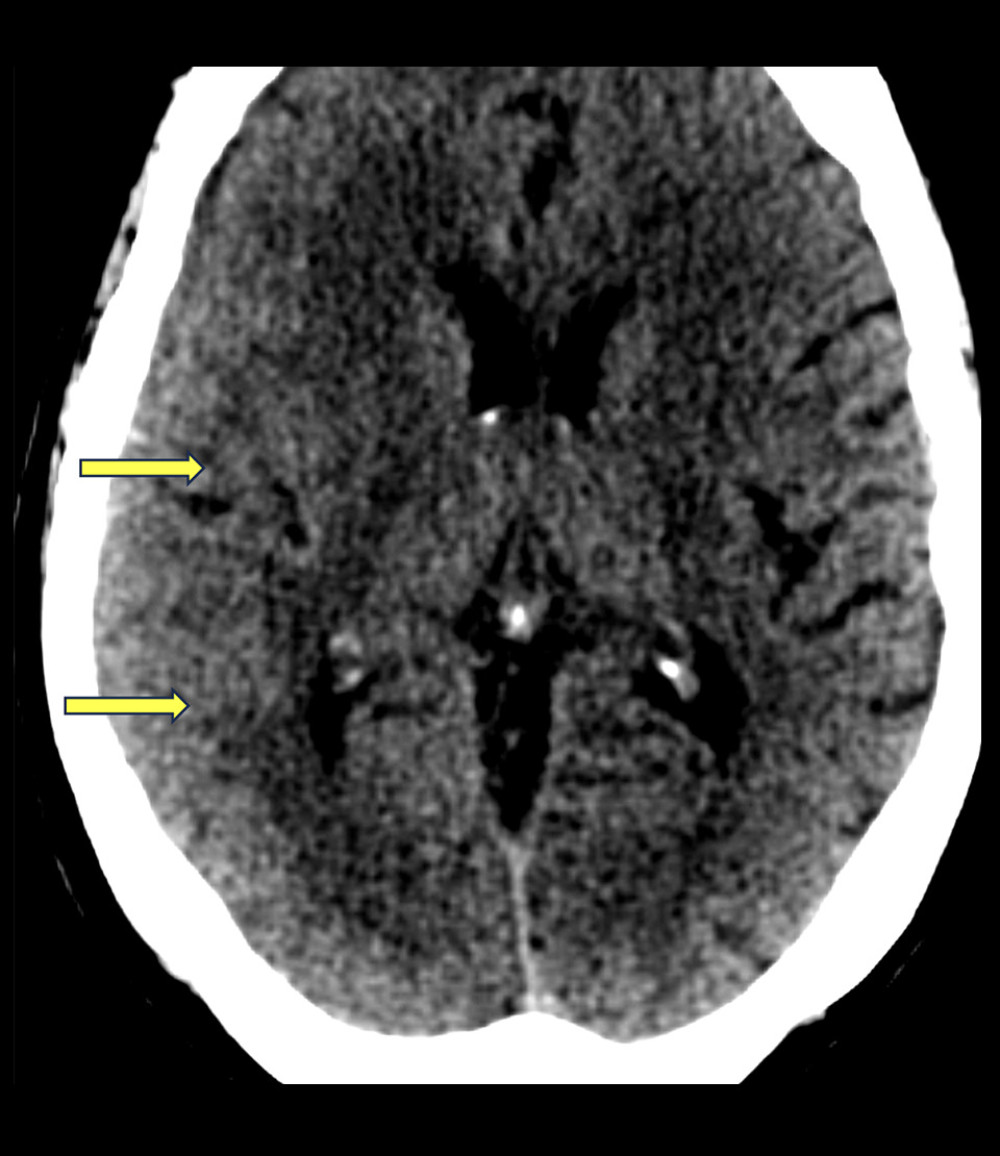 Abnormal soft tissue is observed in the brain on the initial CT scan of the brain without contrast. Sulcal effacement is seen in the right posterior temporal and occipital regions.