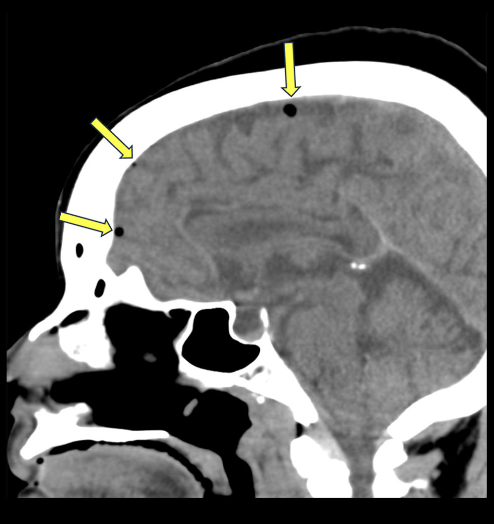Pneumocephalus is visible in the extra-axial space on the initial CT scan of the brain without contrast, most often due to venous air embolus.