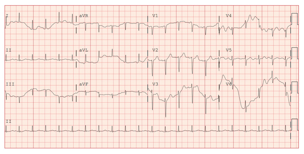 EKG showed sinus tachycardia at 128 beats per minute (bpm) without ischemic changes.