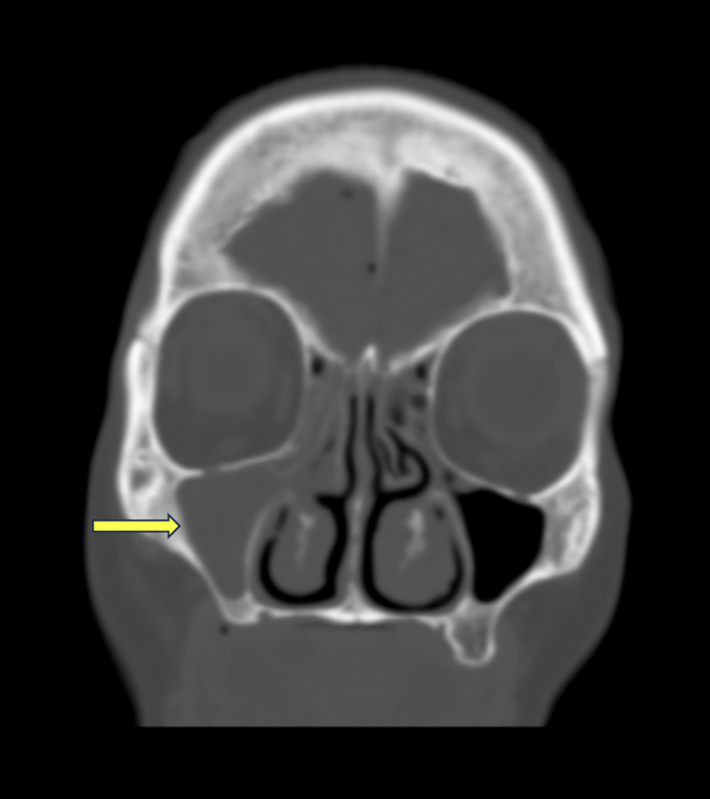 Complete opacification of the right maxillary sinus is seen on initial CT of the brain without contrast. Mucosal thickening and right sinus hypoplasia are also seen.