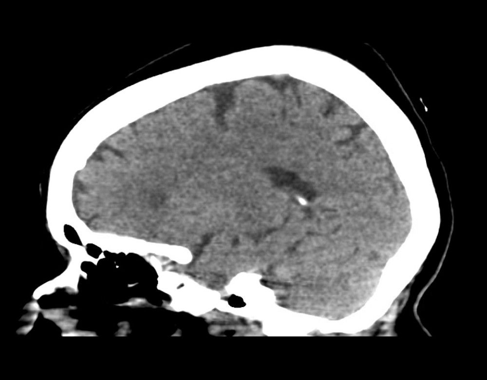 CT brain after right frontal craniotomy without contrast. Interval resolution of previously present small-volume right frontal pneumocephalus.