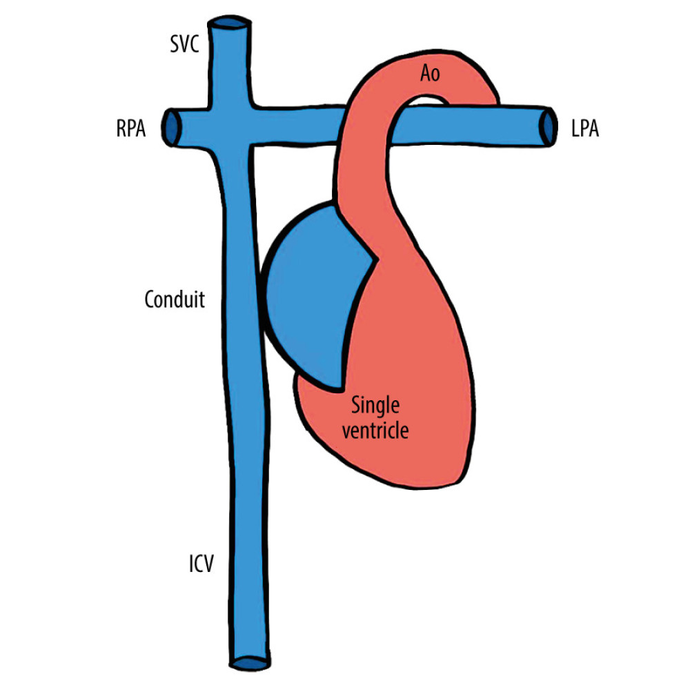 Schematic representation of the patient’s Fontan circulation. SVC – superior vena cava; IVC – inferior vena cava; RPA – right pulmonary artery; LPA – left pulmonary artery; Ao – aorta.