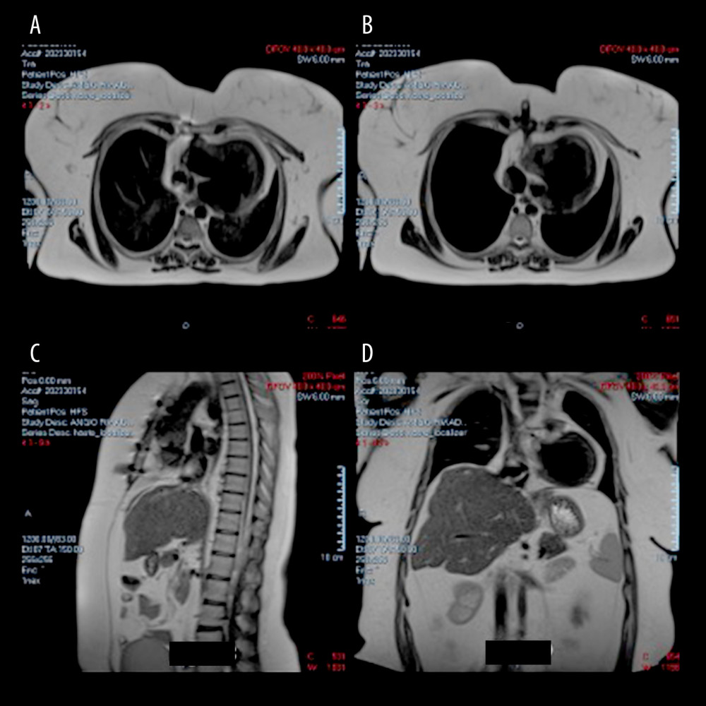 (A, B) Axial magnetic resonance imaging (MRI) scans showing the patient’s single ventricle after Fontan surgery. (C) Sagittal MRI scan showing the patient’s single ventricle after Fontan surgery. (D) Coronal MRI scan showing the patient’s single ventricle after Fontan surgery.