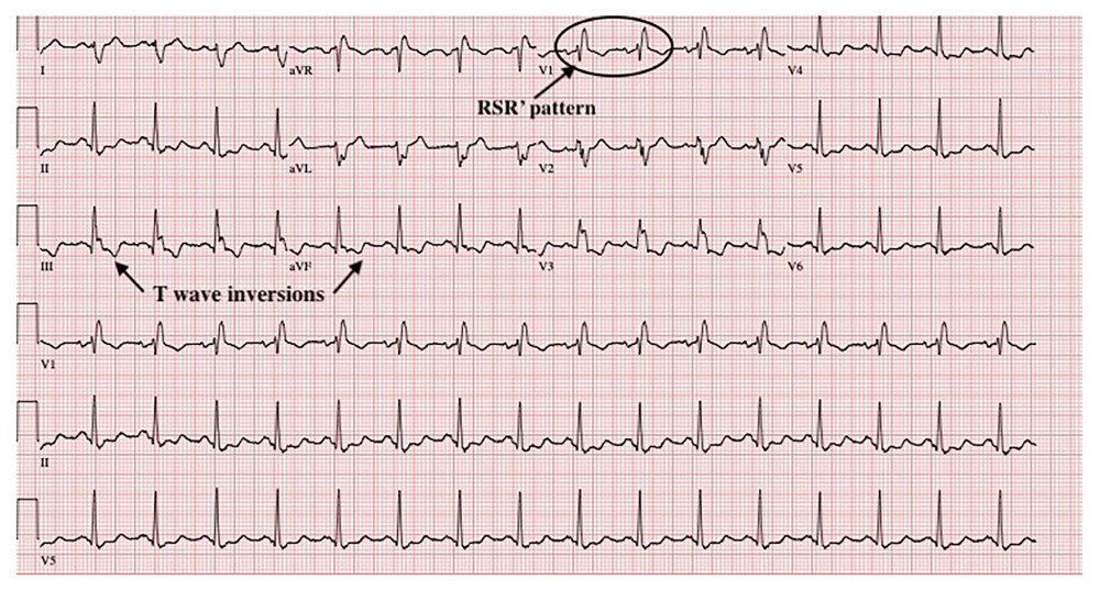 Echocardiogram illustrating a right bundle branch block with ST abnormalities in inferior leads.