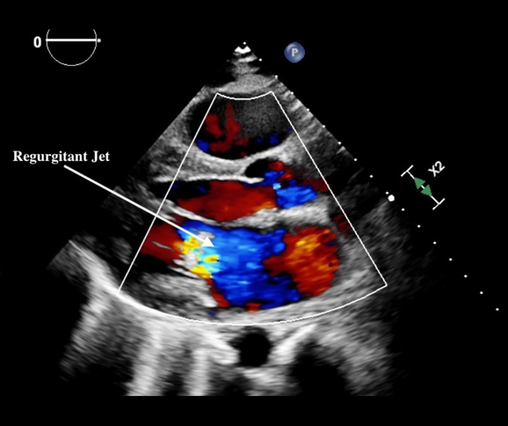 Color flow Doppler transthoracic echocardiogram showing mitral regurgitation in the parasternal long-axis view.