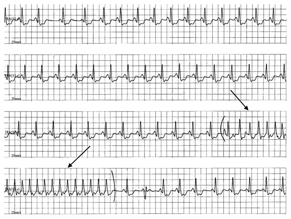 Echocardiogram illustrating progression to a 21-beat run of non-sustained ventricular tachycardia.