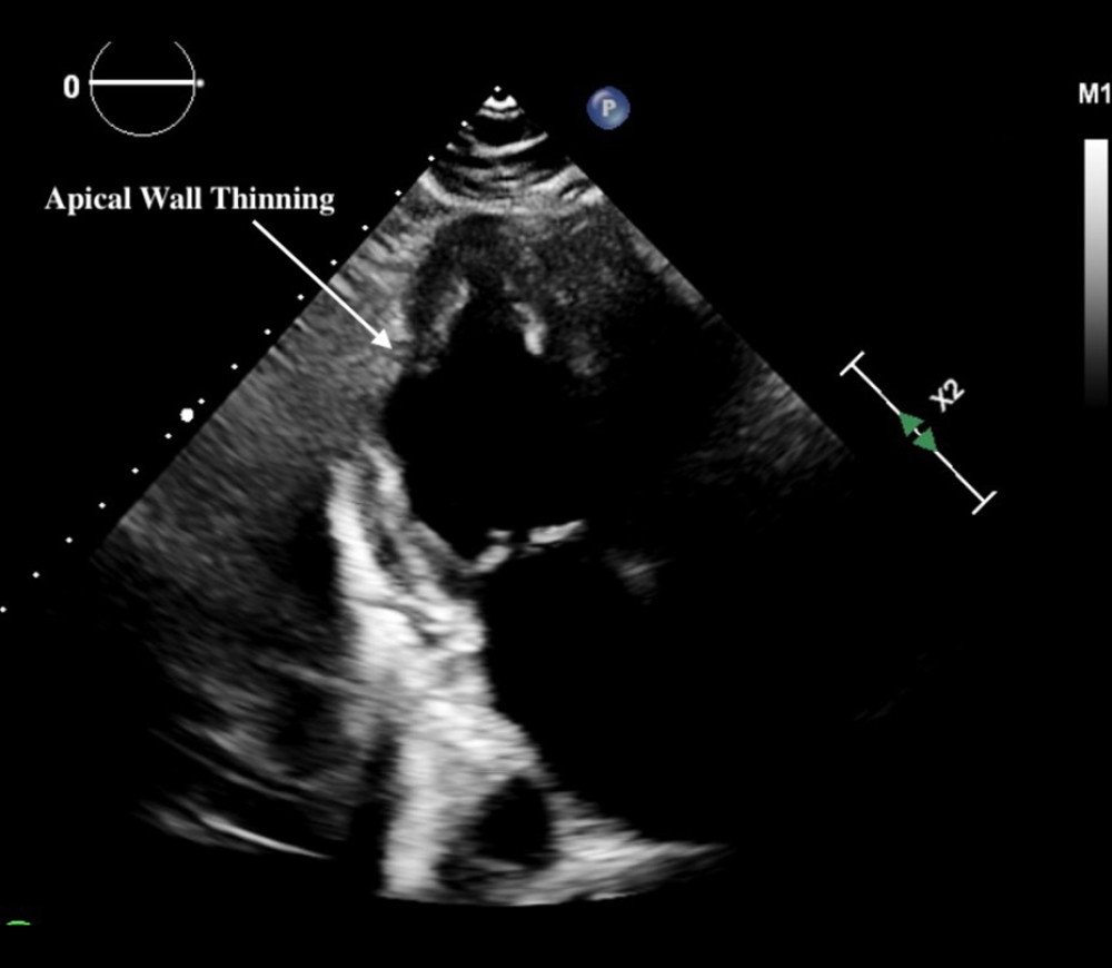 Late gadolinium enhancement cardiac magnetic resonance imaging scan showing apical wall thinning secondary to inflammation from sarcoidosis.