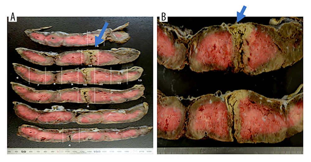 (A, B) Gross appearance of the placenta from the first pregnancy complicated by intraplacental choriocarcinoma. Gross examination of the placenta from the first pregnancy revealed a well-demarcated, brownish-white nodular lesion measuring 4 cm in diameter, with extensive areas of necrosis (arrows).