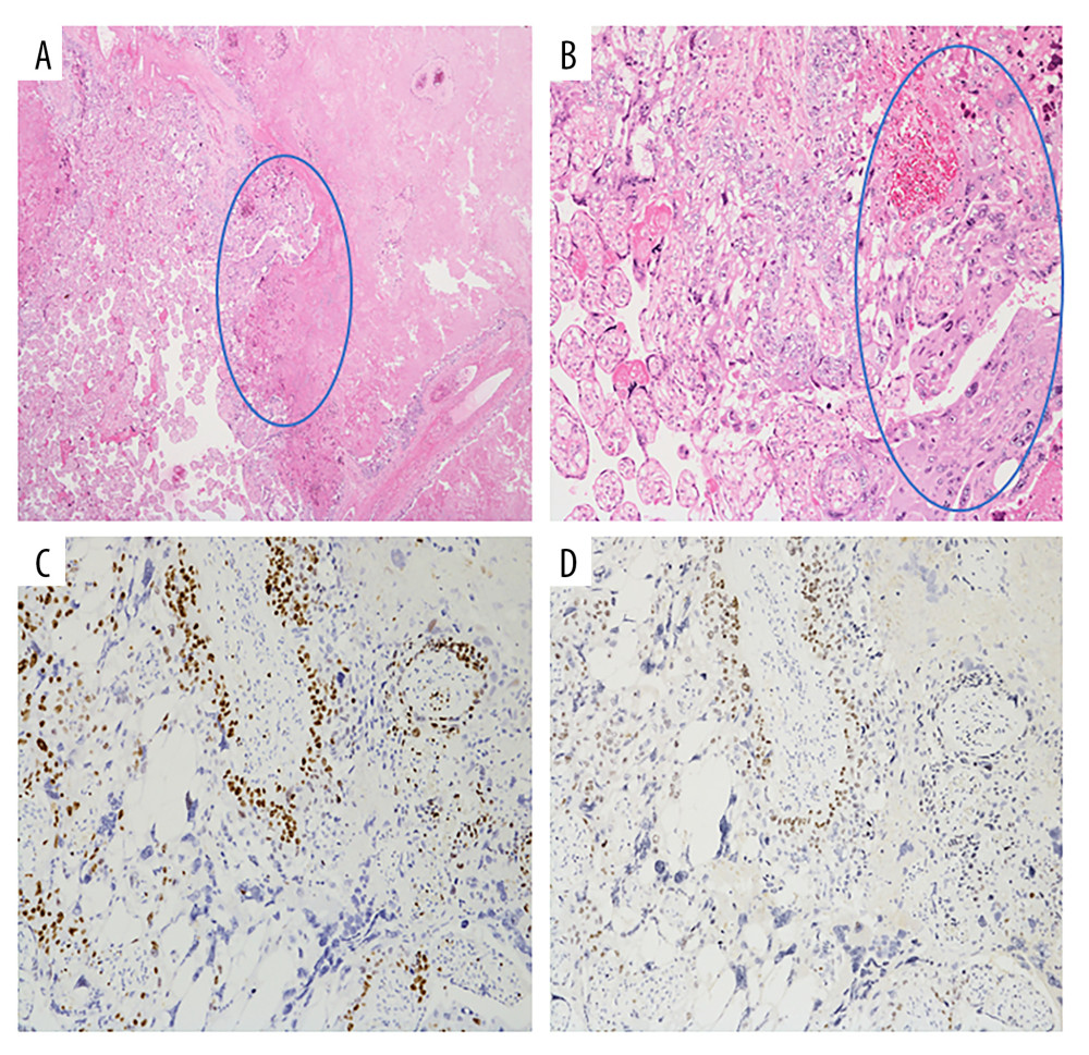 Histopathological findings of the placenta from the first pregnancy complicated by intraplacental choriocarcinoma(A) Hematoxylin and eosin (H&E) staining, ×20. The right side of the image shows a broad area of coagulative necrosis. Viable atypical cells proliferated (▲) at the interface with adjacent normal villous tissue (left side). (B) H&E staining, ×200. Atypical trophoblastic proliferation with a mixture of mononucleated cytotrophoblasts (▲) and multinucleated giant trophoblastic cells (syncytiotrophoblasts) (△). (C) Ki-67 immunostaining, ×100. A high proportion of mononuclear tumor cells showed Ki-67 positivity, indicating a high proliferative index. (D) p63 immunostaining, ×100. A subset of mononuclear tumor cells showed nuclear positivity for p63.