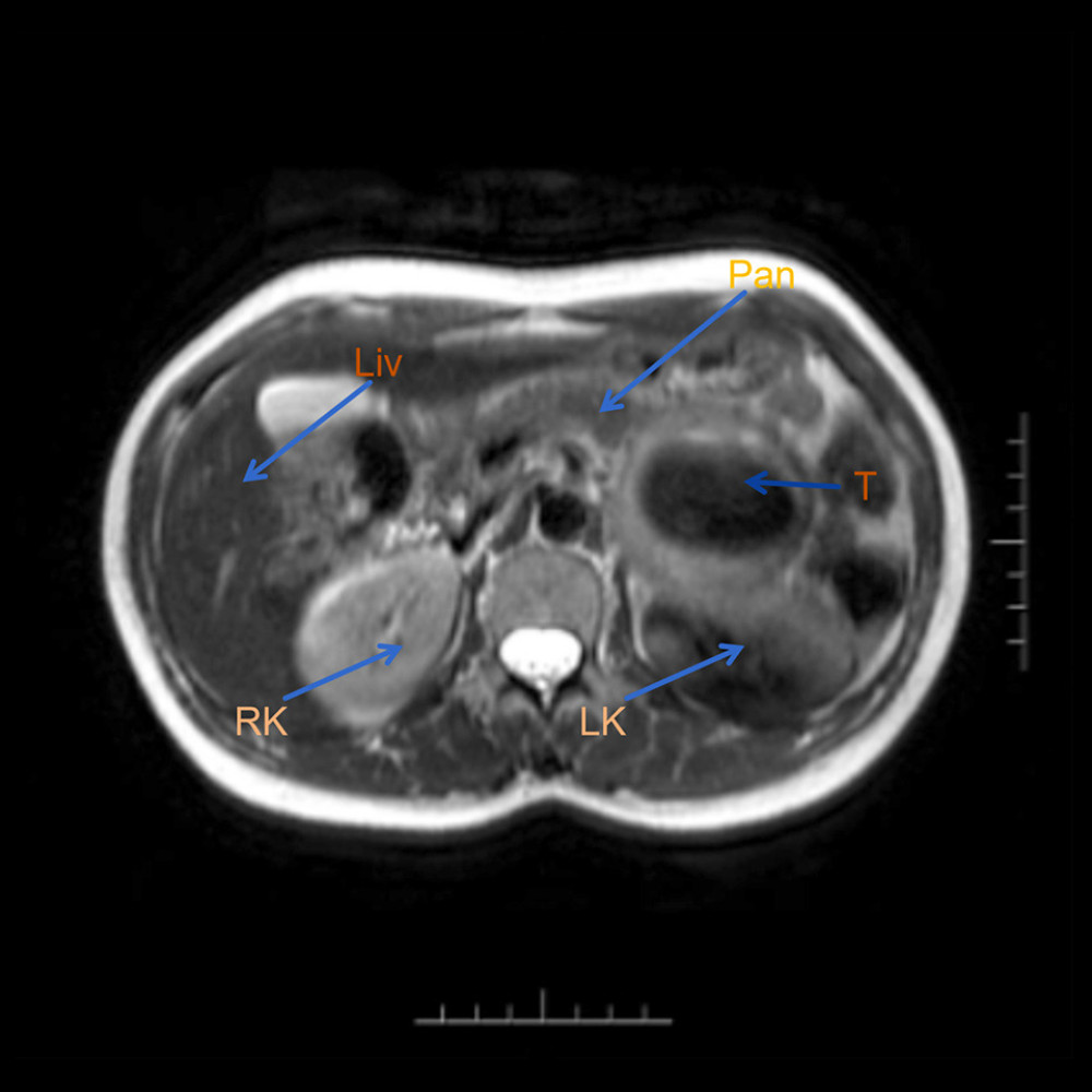 Preoperative MRI (RK – right kidney; LK – left kidney; T – tumor; Pan – pancreas; Liv – liver).