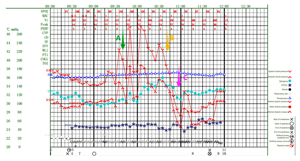Intraoperative anesthesia record. A) Use sodium nitroprusside. B) Use hydrocortisone. C) Use norepinephrine and metaraminol.