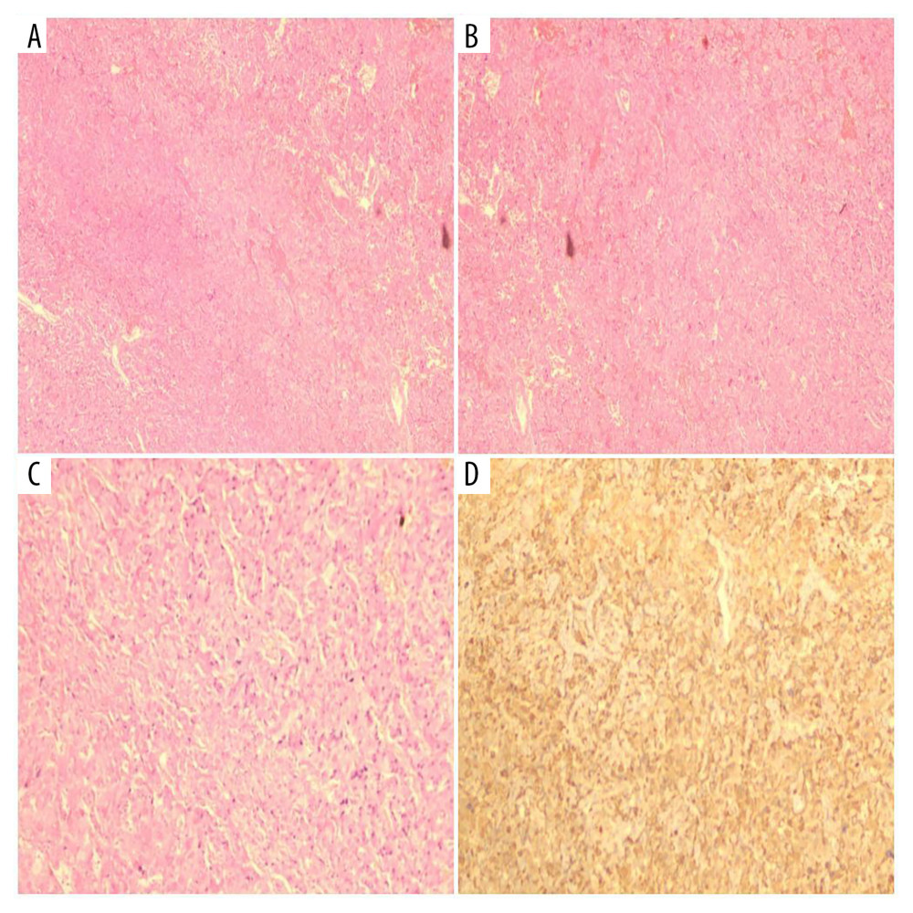 Pathology results showing adrenal pheochromocytoma. (A, B) Staining with hematoxylin-eosin (HE); Observation perspective: Two-dimensional planar observation; Internal scale: 1 unit=100–200 μm (low-power). (C) Staining with hematoxylin-eosin (HE); Observation perspective: Two-dimensional planar observation; Internal scale: 1 unit=25–50 μm (high-power). (D) Immunohistochemical staining; Observation perspective: Two-dimensional planar observation; Internal scale: 1 unit=25–50 μm (high-power); Immunohistochemical Results: S100(+), PMS-2 (machine-stained) (+), MLH1 (machine-stained) (focal +), MSH2 (machine-stained) (focal +), MSH6 (machine-stained) (+), β-catenin (membranous +), inhibin-α(−), Ki-67(1%), ATRX(+), SF-1 (+), P27(+), CD56(+), CgA(+), Syn(+), CKL(−), SDHB(+).