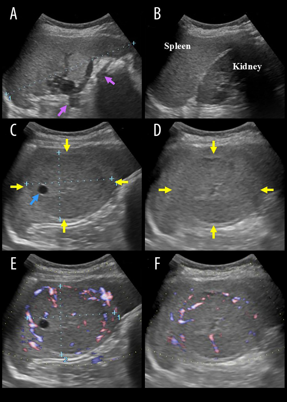 Ultrasonography findingsCollateral vessels were seen (A, purple arrows), and splenomegaly (143×65 mm) was observed (B). A hypoechoic splenic mass measuring 70×55 mm was detected incidentally (C, D, yellow arrows). This regularly shaped lesion involved a cystic component (C, blue arrow). The solid component showed hypervascularity with Doppler ultrasonography (E, F).