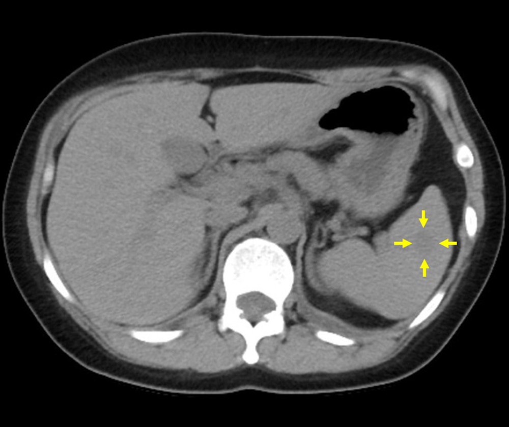 Tumor size during imaging performed 6 years prior to presentation at our hospitalThe splenic mass measured 13 mm 6 years prior to presentation at our hospital (yellow arrows). The blue arrow indicates the cystic lesion.