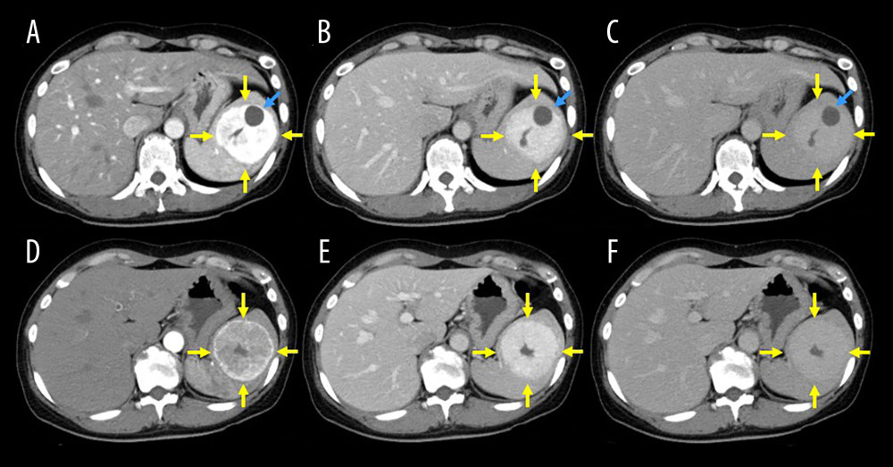 Contrast-enhanced computed tomography findingsThe splenic tumor consisted of a solid component (yellow arrows) and a cystic lesion (blue arrows). Imaging clearly shows homogeneous and strong enhancement in the early phase (A, B, D, E), with prolonged strong enhancement in later phases (C, F).