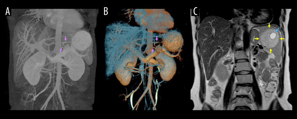 Three-dimensional magnetic resonance imaging findingsThe estimated splenic volume was 650.7 mL with computed tomography volumetry. Collateral vessels are visible around the splenic hilum (A, B, purple arrows). In T2-weighted imaging, the solid component (yellow arrows) and cystic lesion (blue arrow) both show relatively high intensity (C).