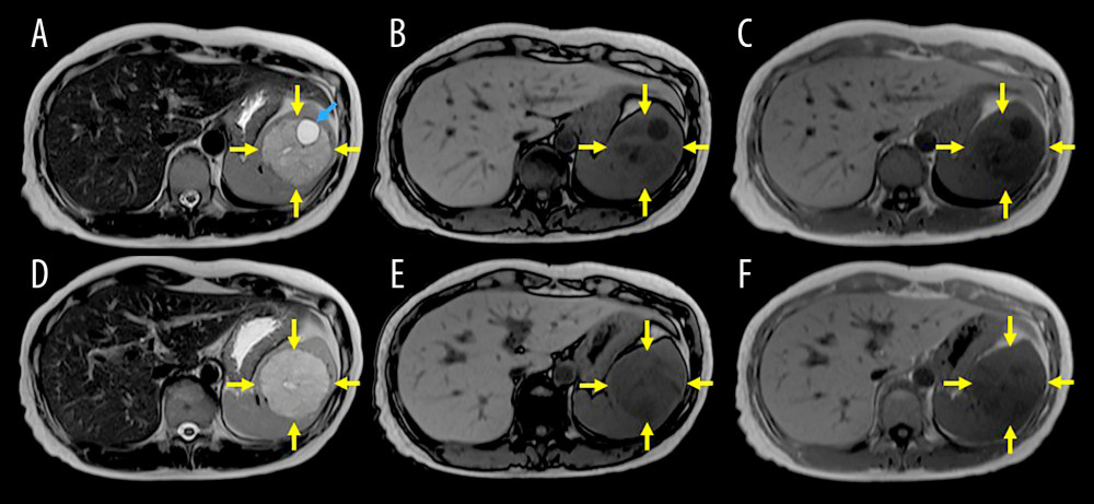 Magnetic resonance imaging findingsIn T2-weighted imaging, the solid component (yellow arrows) and cystic lesion (blue arrow) both show relatively high intensity (A, B). In T1-weighted imaging gradient-echo sequences, neither the opposed-phase (C, D) nor the in-phase (E, F) show the solid component.