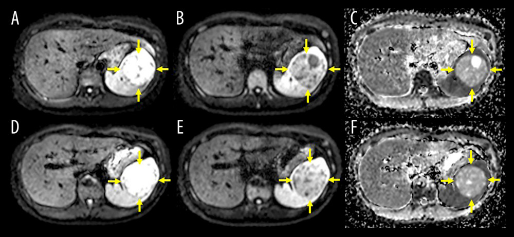 T2-weighted and high b-factor diffusion-weighted magnetic resonance imaging findingsImages (b-values 0–800 s/mm2) demonstrate no positive enhancement in the solid component of the lesion (A–D, yellow arrows).The solid component also shows no signal suppression in the apparent diffusion coefficient map (E, F, yellow arrows).