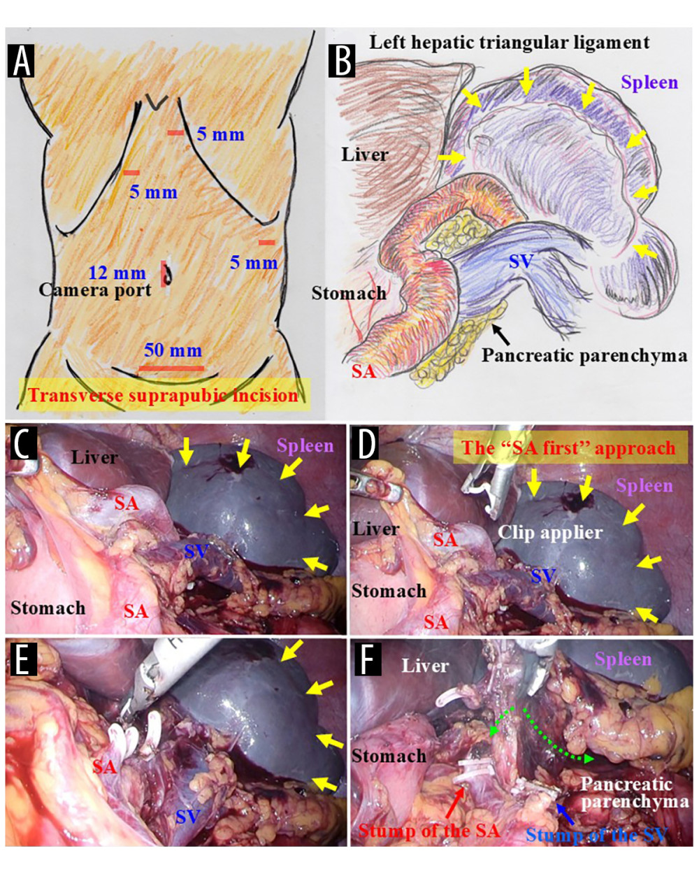 Initial surgical proceduresAn incision was created in the umbilicus for the camera port, and 3 working ports were placed (A). A large splenic tumor is visible intraoperatively (B–E, yellow arrows). The splenic artery (SA) and splenic vein (SV) were both skeletonized distally (B, C). To control intraoperative bleeding from the spleen and to shrink the spleen for subsequent removal through the abdominal wall, the SA was ligated before the SV (D, E). The spleen was mobilized from the retroabdominal space by cutting the connective tissue (F, green dotted arrows).