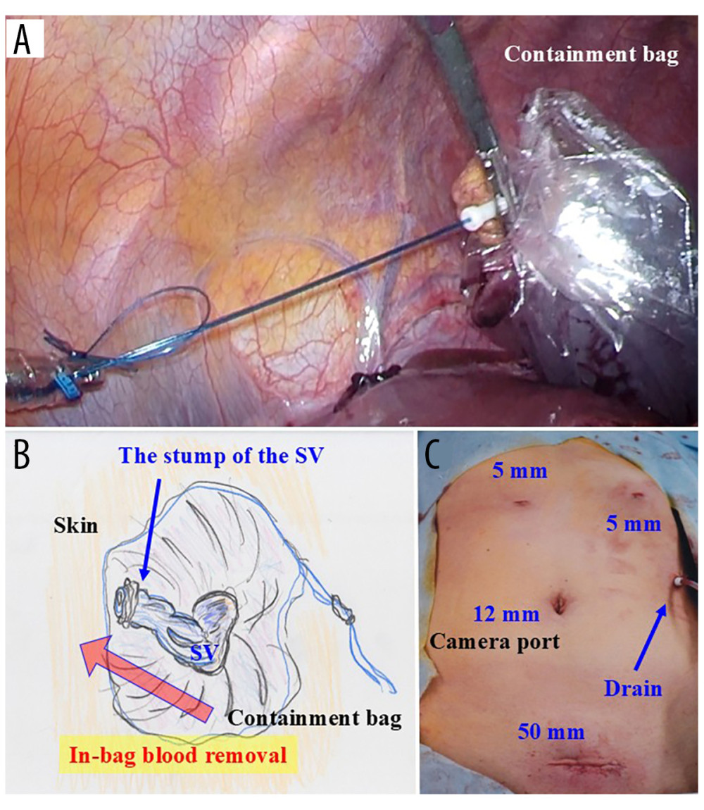Additional surgical proceduresThe spleen was caught in the containment bag (A). A transverse skin incision was made cranially at the pubic bone, and the mouth of the containment bag was introduced extraperitoneally through the abdominal wall. The containment bag was opened, and the stump of the splenic vein (SV) was cut within the bag (B). Blood in the resected spleen was then removed to further shrink the spleen, and an intraperitoneal drain was placed through the port incision (C).