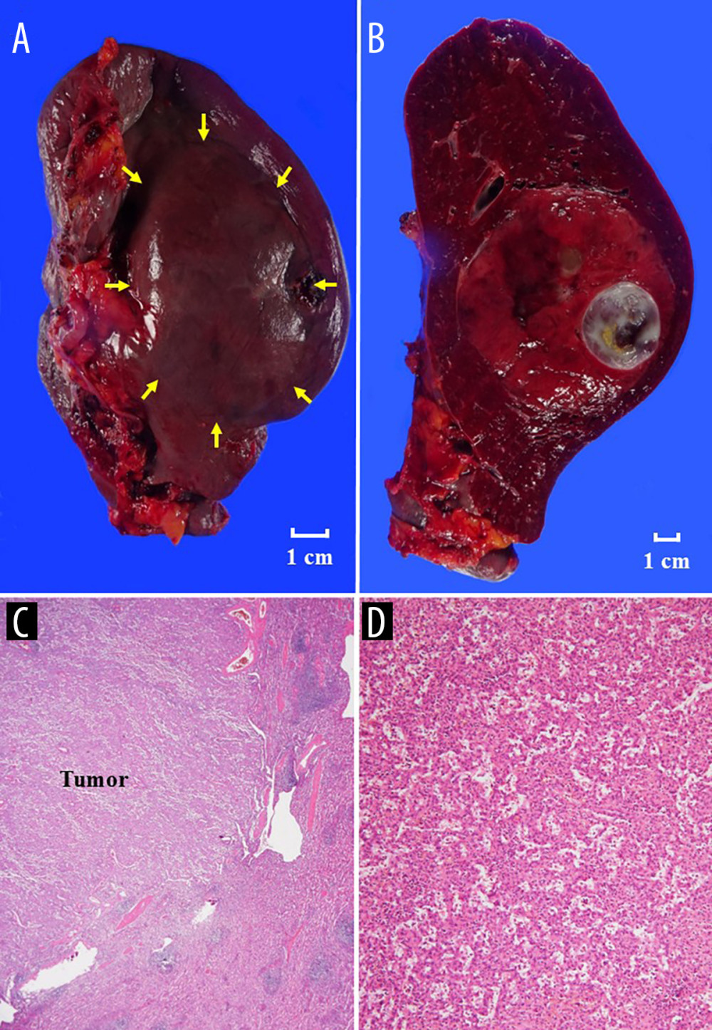 Histopathological findingsThe splenic tumor (yellow arrows) consisted of a solid component and a cystic lesion (A, B). Histopathological findings are shown with hematoxylin and eosin staining at ×40 (C) and ×200 (D) magnification. A mixture of unorganized vascular channels and fibrotic cords of splenic red pulp-like area were clearly observed in hematoxylin and eosin stain (D).