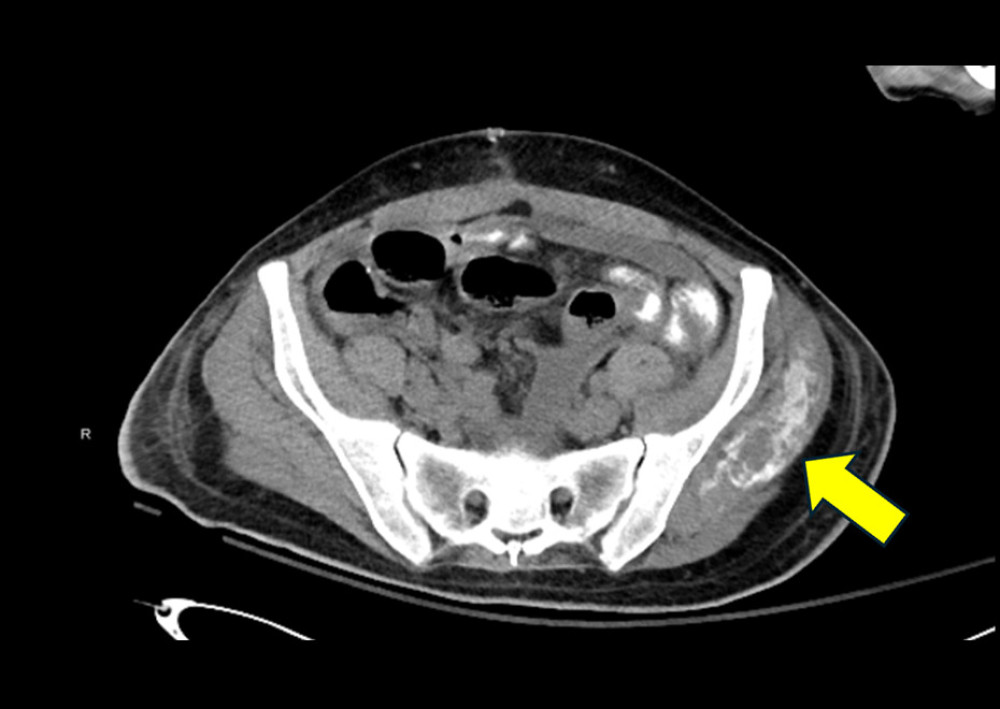 Abdominal computed tomography scan. Yellow arrow indicates substantial calcification in the left gluteal region. Note the mild calcification in the anterior abdominal wall musculature.