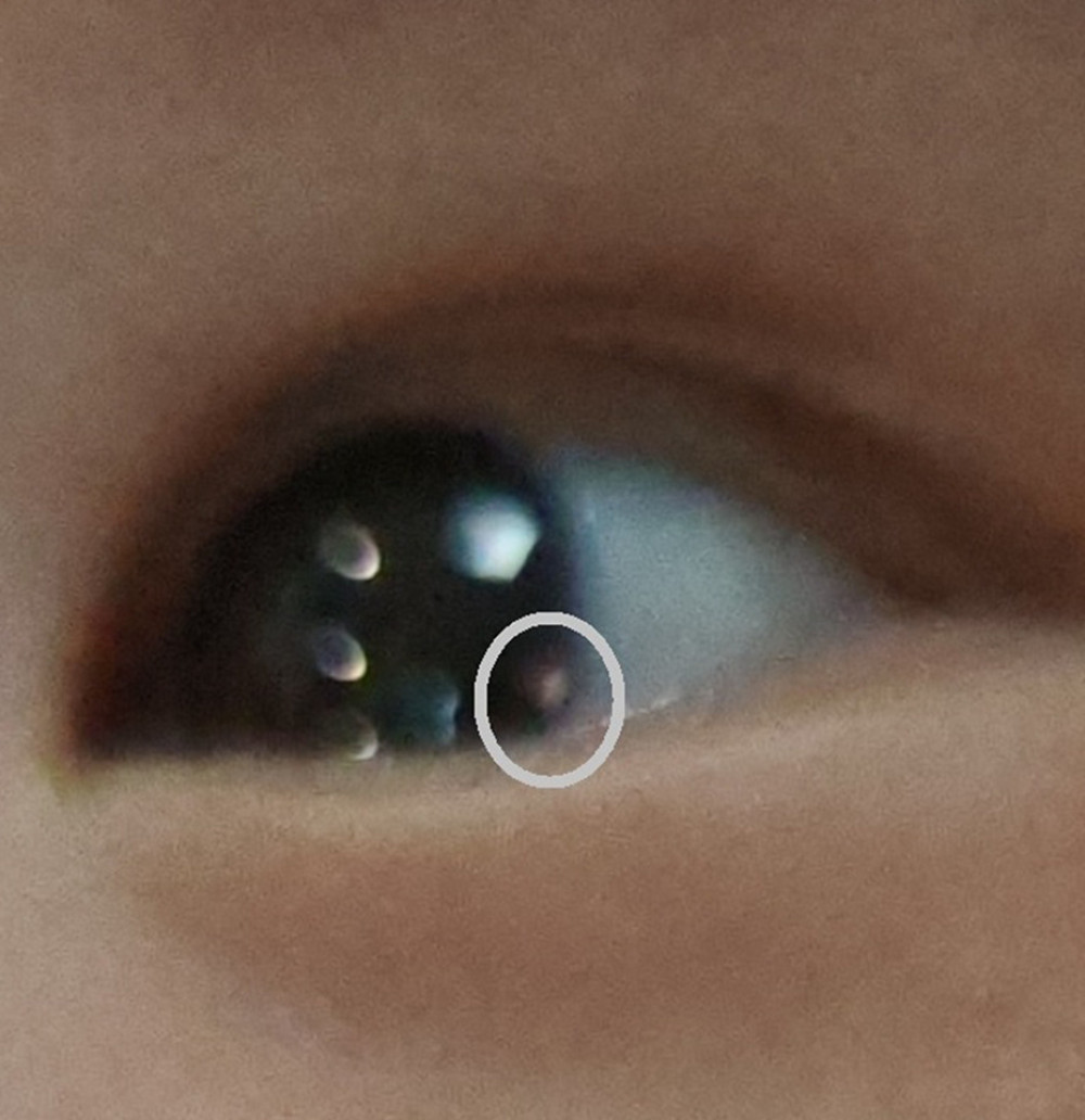 Photo caption of a corneal foreign body (CFB) in the 2-month-old male. The white solid circle outlines an oval, pink plastic CFB located on the corneal surface, close to the inferior temporal limbus, with a diameter of approximately 0.8 mm.