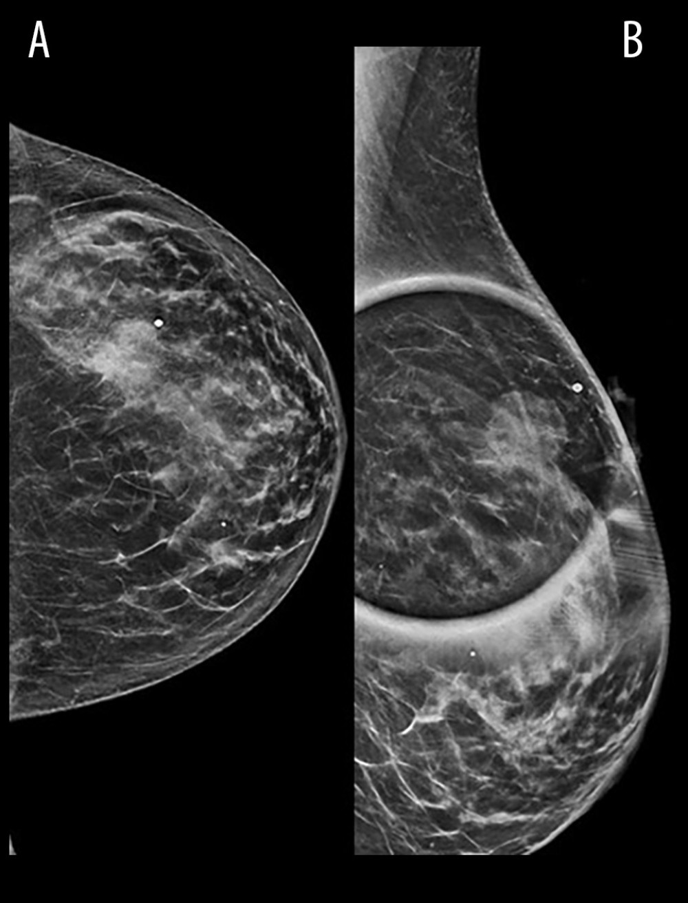(A) Mammogram revealing a 2.6-cm mass in the left breast upper outer quadrant. (B) CC view confirming the breast mass.