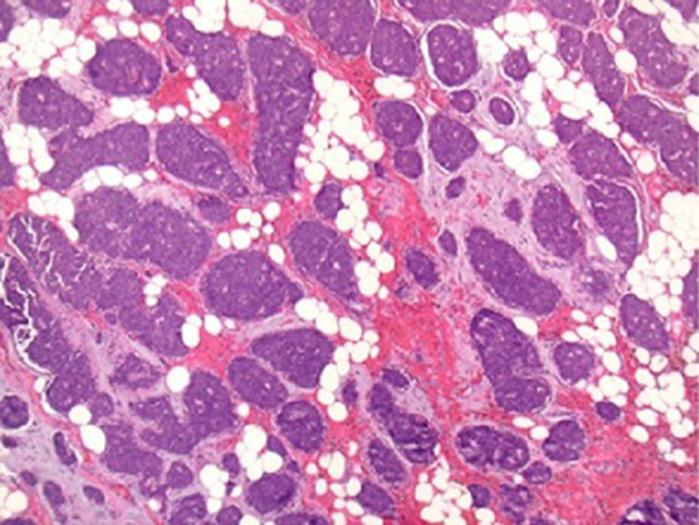 Low-magnification view (40×) of the tumor with H&E stain, showing tumor cells arranged in tight organoid nests with delicate intervening fibrovascular stroma. Almost the entire tumor shows the same pattern.