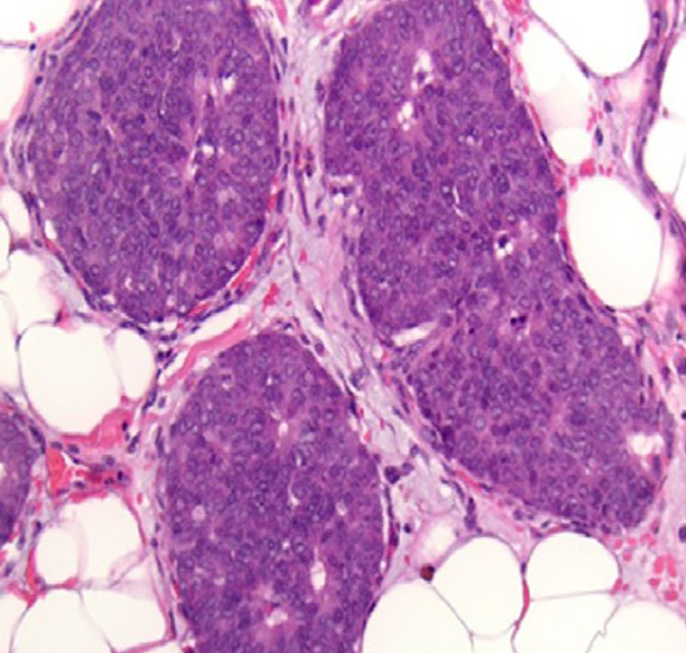At a higher magnification (200×), the tumor cells show many typical features of neuroendocrine morphology. The tumor cells are polygonal with granular eosinophilic cytoplasm. The classical salt-and-pepper stippled chromatin is visible in a minority of tumor cells. Neuroendocrine tumors of the breast in general, as also seen in this case, tend to show a lower Nottingham nuclear grade of 1 or 2 out of 3.