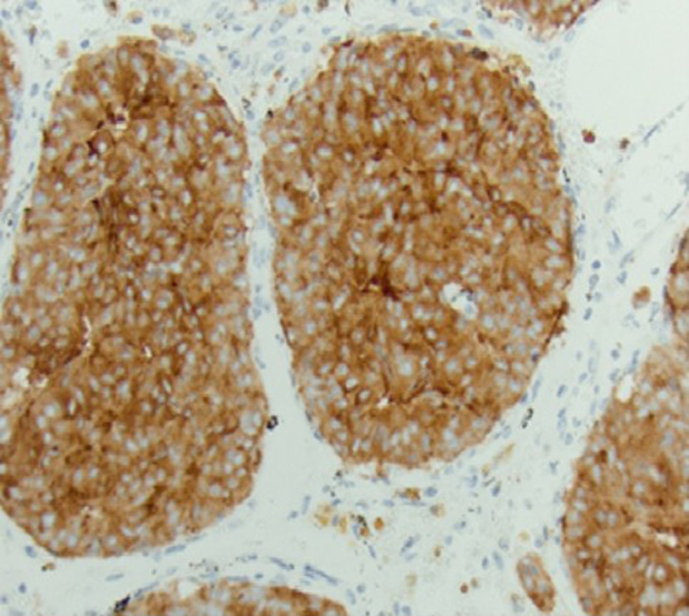 Immunohistochemical stain for synaptophysin, a typical marker for neuroendocrine differentiation, displays cytoplasmic labeling within the tumor cells, confirming the neuroendocrine nature of the tumor.