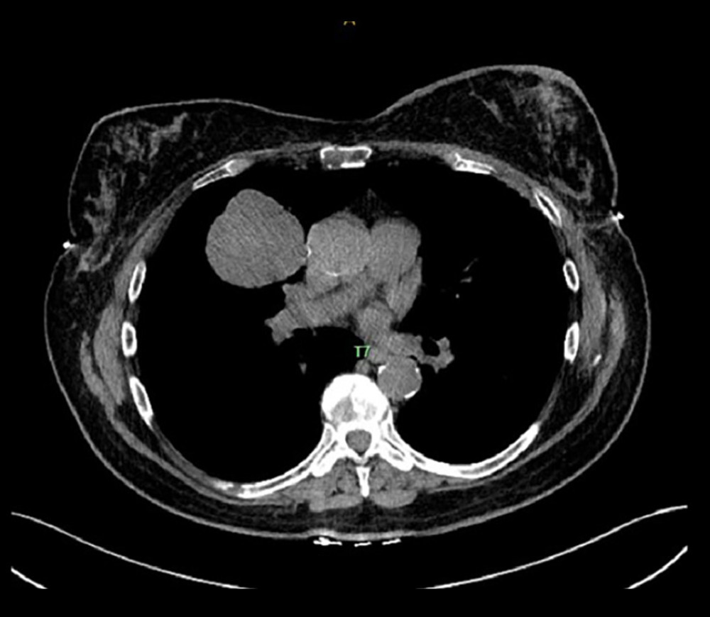 Computed tomography showing the right upper-lobe lung mass and mediastinal lymphadenopathy.