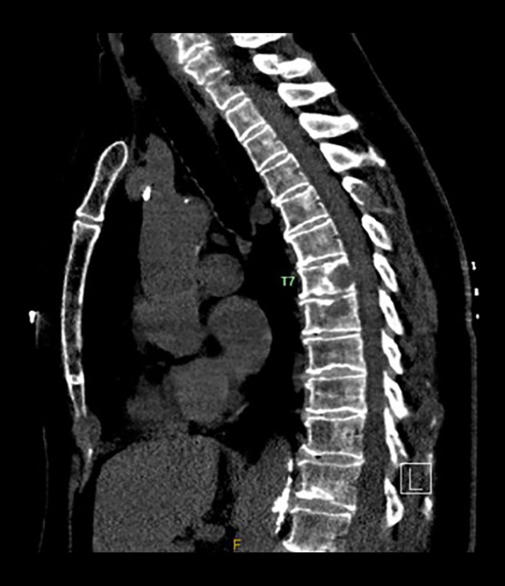 Computed tomography of the thoracic spine showing a T7 vertebral compression fracture.