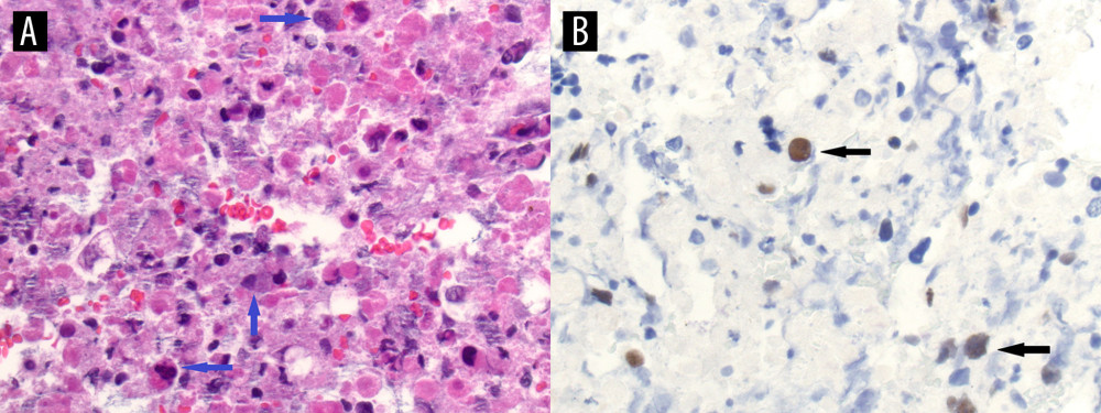 Lung involvement by metastatic breast carcinoma. (A) High-power magnification image of the H&E-stained fine-needle aspirate from the lung lesion appears to be predominantly necrotic with an admixture of inflammatory cells, macrophages, and a few probable metastatic malignant cells (blue arrows). (B) Immunohistochemical stain for a breast marker, GATA3, was performed. The stain labeled rare, scattered, malignant-appearing cells (black arrows), confirming the presence of metastatic breast carcinoma to the lung.