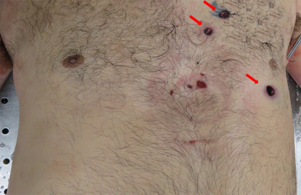 Anterior chest showing 3 entrance gunshot wounds clustered in the precordial region. Arrows denote wound sites. No soot or stippling visible externally. No visible soot or gunpowder stippling around wounds. Note the medical artifacts caused by a LUCAS device used for chest compressions.