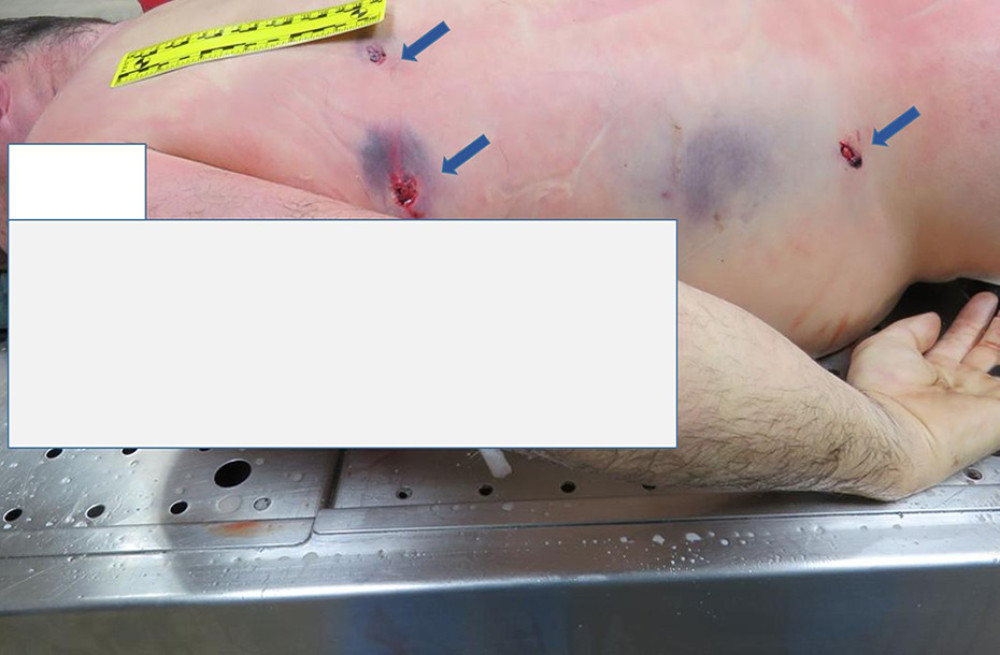 Three exit gunshot wounds on the left side of the back and left flank region (blue arrow) associated with 3 entrance wounds on the chest. The margins showed lacerated features.
