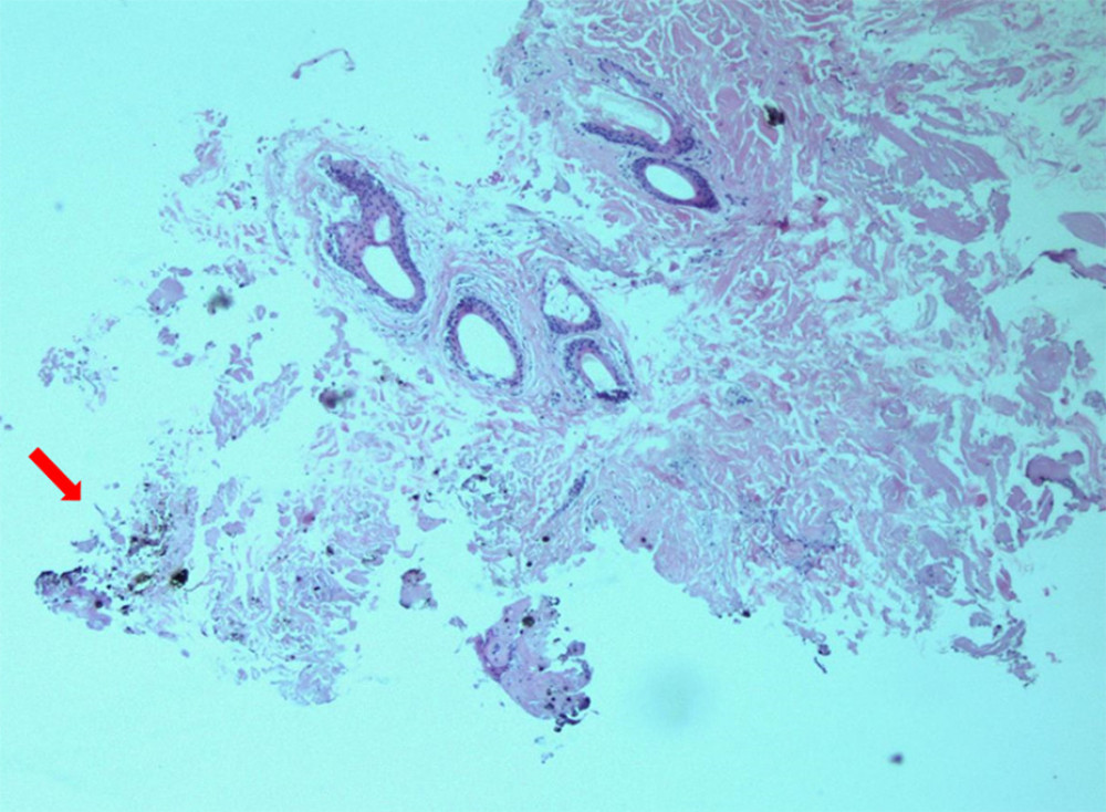 Histological section (H&E stain, 40× magnification) of subcutaneous tissue demonstrating sparse embedded gunpowder particles along the wound tract, consistent with close-range discharge. Disruption of the subcutaneous tissue, coagulation necrosis, and gunpowder particles deposit.