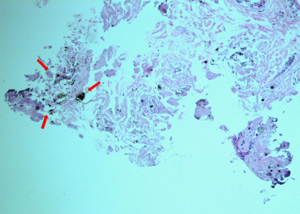Histological section of subcutaneous tissue at wound entrance with high power (100×). High power confirmed the feature of the miniscule gunpowder particles.